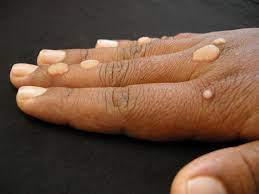 types of warts images symptoms and