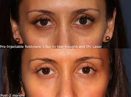 eye rejuvenation cosmetic laser