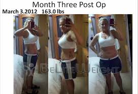 gastric sleeve weight loss journey
