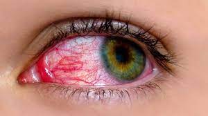 8 common myths about pink eye
