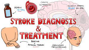 stroke diagnosis and treatment acute