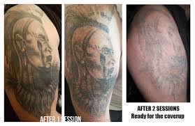 Having established relationships with local tattoo shops will be a great asset to your practice. Laser Tattoo Removal Ink Illusions