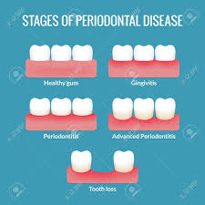 Stages Of Periodontal Disease From Healthy Gums To Gingivitis