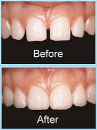 Image result for dental veneers