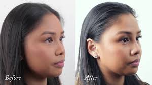 View nose job before and after photos of primary rhinoplasty procedures performed by dr. Non Surgical Rhinoplasty For Asian Noses Youtube