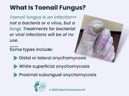 toenail fungus what is it how to