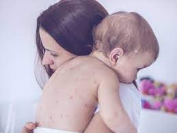 La varicelle chez le bébé : comment le soigner et soulager ? | PARENTS.fr