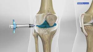 knee pain without surgery khou