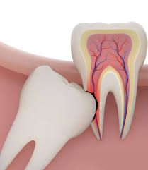 wisdom teeth removal perth belmont