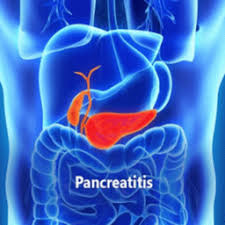 does pancreais cause yellow stool or