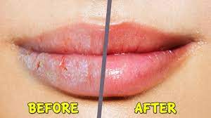 dry ed chapped lips in winter