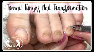 thinning thick toenail fungus nail