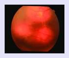 ocular tubercles