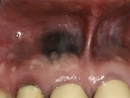 black gums causes and treatment