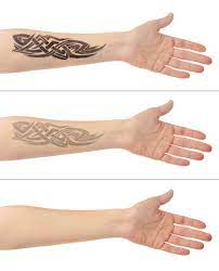 laser tattoo removal silhouette spa