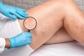 can i avoid spider veins completely