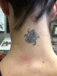 laser tattoo removal pittsburgh black