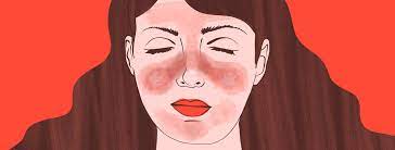 what is a lupus erfly rash and how