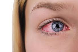 9 most common causes of red eyes