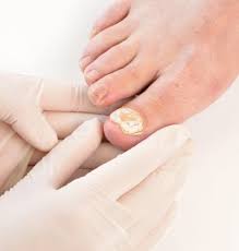 toenail fungal infection southernmost
