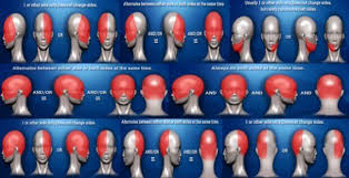 headache chart location and symptoms