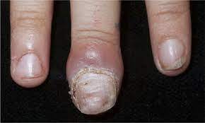 chronic nail bed inflammation in a 6
