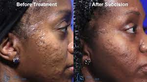 acne scar treatment for black skin