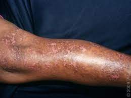 diabetes and discoloration of the skin