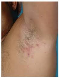 hidradenitis suppurativa treatment