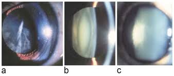 A Frontal View Of A Cortical Cataract B Cross Sectional