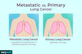 metastatic cancer to the lungs