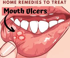 home remes and treatment for canker