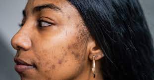 types of acne scars pictures of boxcar
