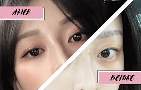 my double eyelid surgery review