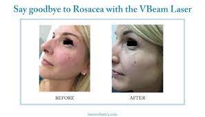 rosacea with the vbeam laser