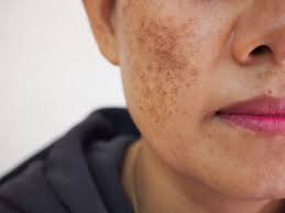 sun damage freckles
