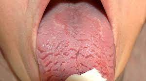 fissured tongue pictures symptoms