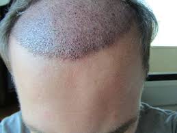 Or are there examples which some guys had a significant transform after 9 months. Post Hair Transplant Surgery Recovery