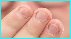stop nail biting causes risks and