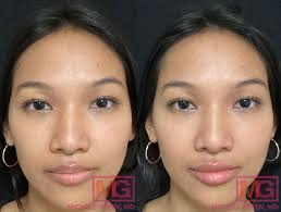 lip fillers nyc lip injections
