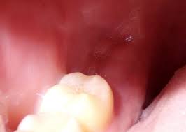 How can you tell if you have a blood clot? How Long After Getting Your Wisdom Teeth Out Do Your Gums Stop Feeling Swollen It S Been 14 Days But I Still Feel Like My Gums Are Swollen Almost Chewy Quora