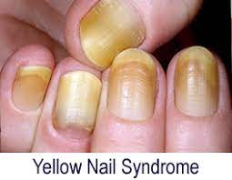 fingernail problems split yellow or