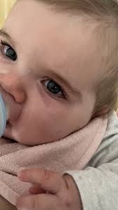 baby has red skin below her eye photo