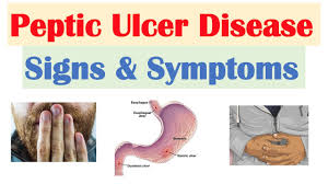 peptic ulcer disease signs symptoms