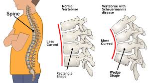Scheuermann's disease, first described in 1920, is one of the adolescent osteochondroses. Scheuermann S Disease Treatment Advanced Spinal Bracing Solutions