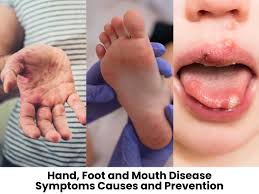 hand foot and mouth disease symptoms