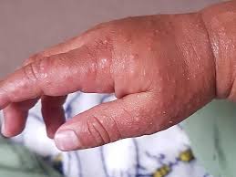 It is characterized by sores in the mouth, and a painful rash on the hands and feet. Hand Foot And Mouth Disease Babycenter
