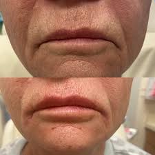 before and after botox for lips in st