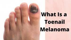 what is a toenail melanoma you