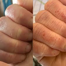 healing bad hand eczema what allergy